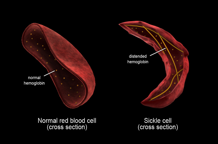 Understanding sickle cell and its related conditions - Graphic Online